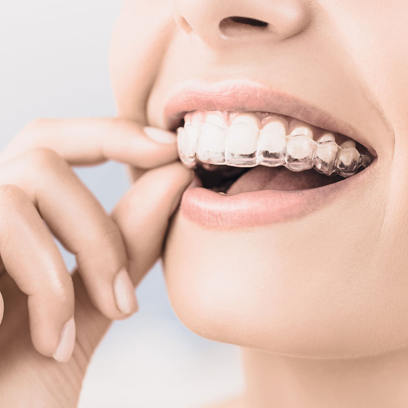 Invisible Braces: The Clear Aligner Method