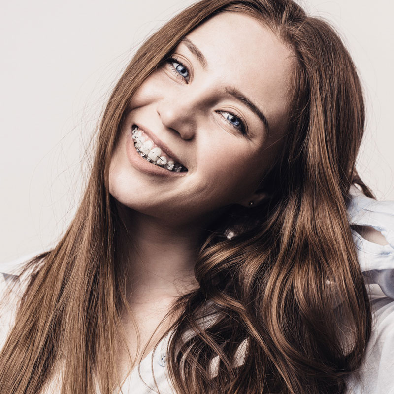 Clear Braces