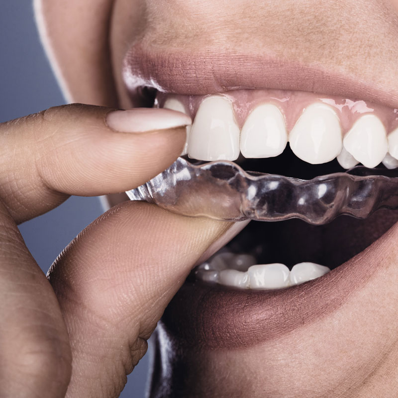 Invisalign
