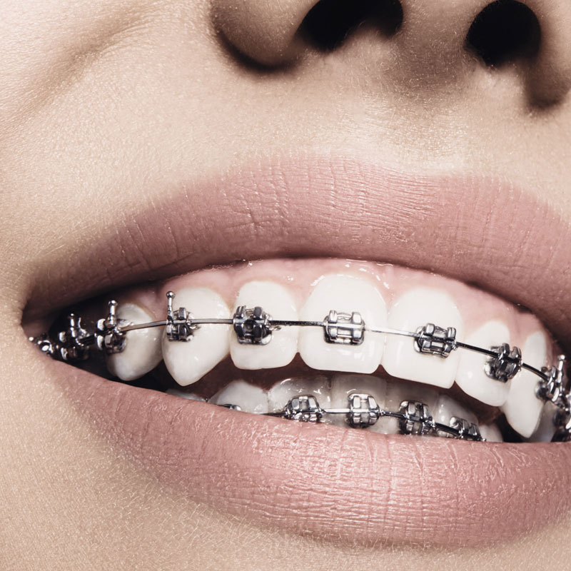 Metal Braces