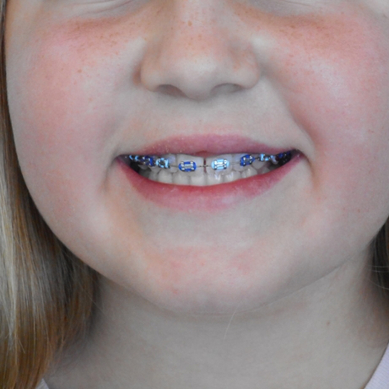 Metal Braces