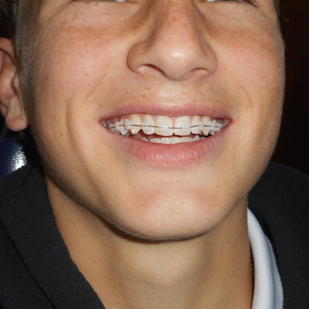 Ceramic Braces