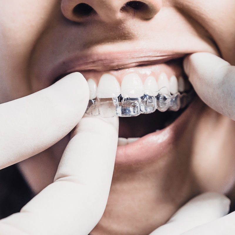 Invisalign