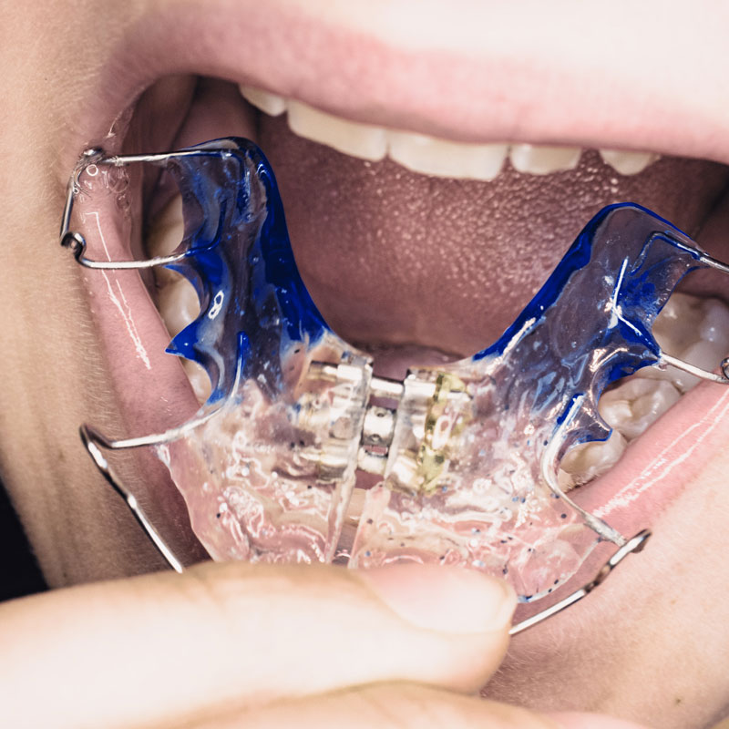 Maxillary Palatal Expander